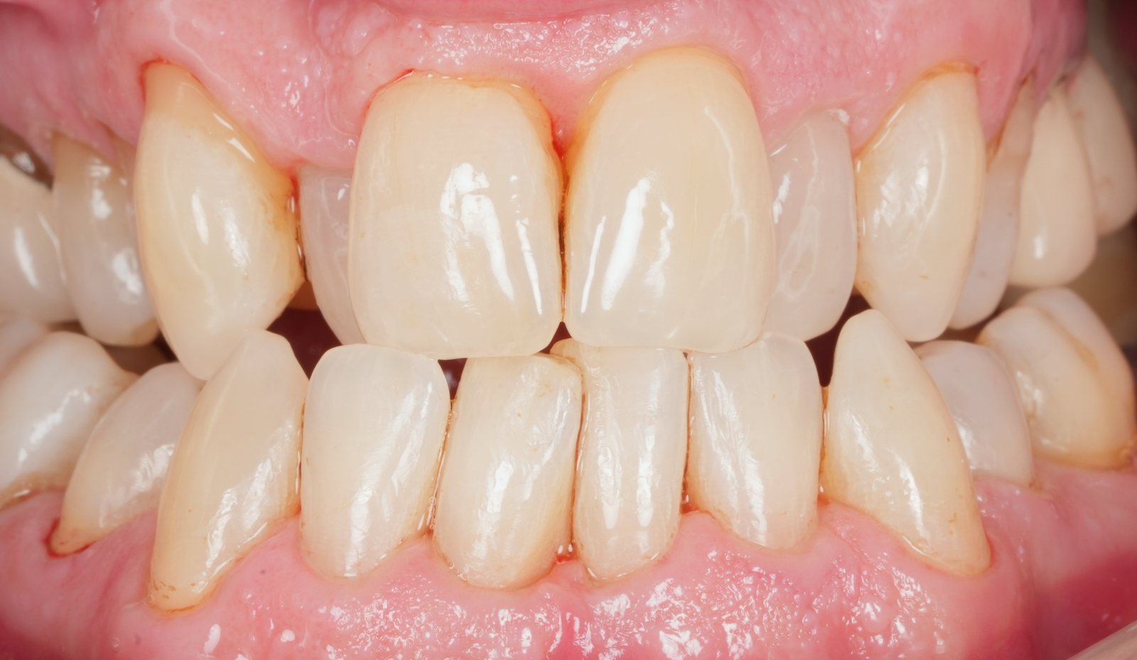 The same teeth clean and stain-free after a single EMS Airflow session