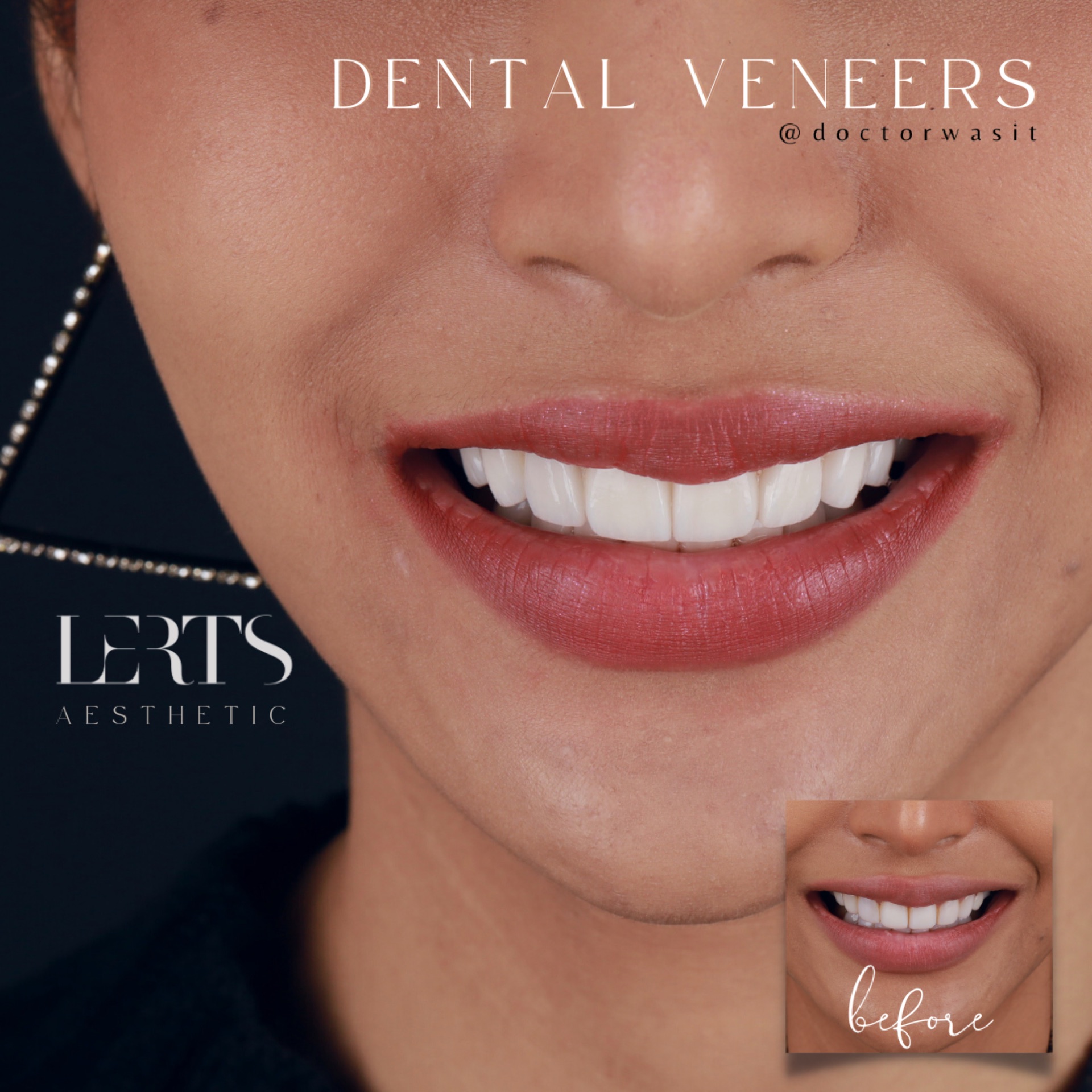 Veneer case 08