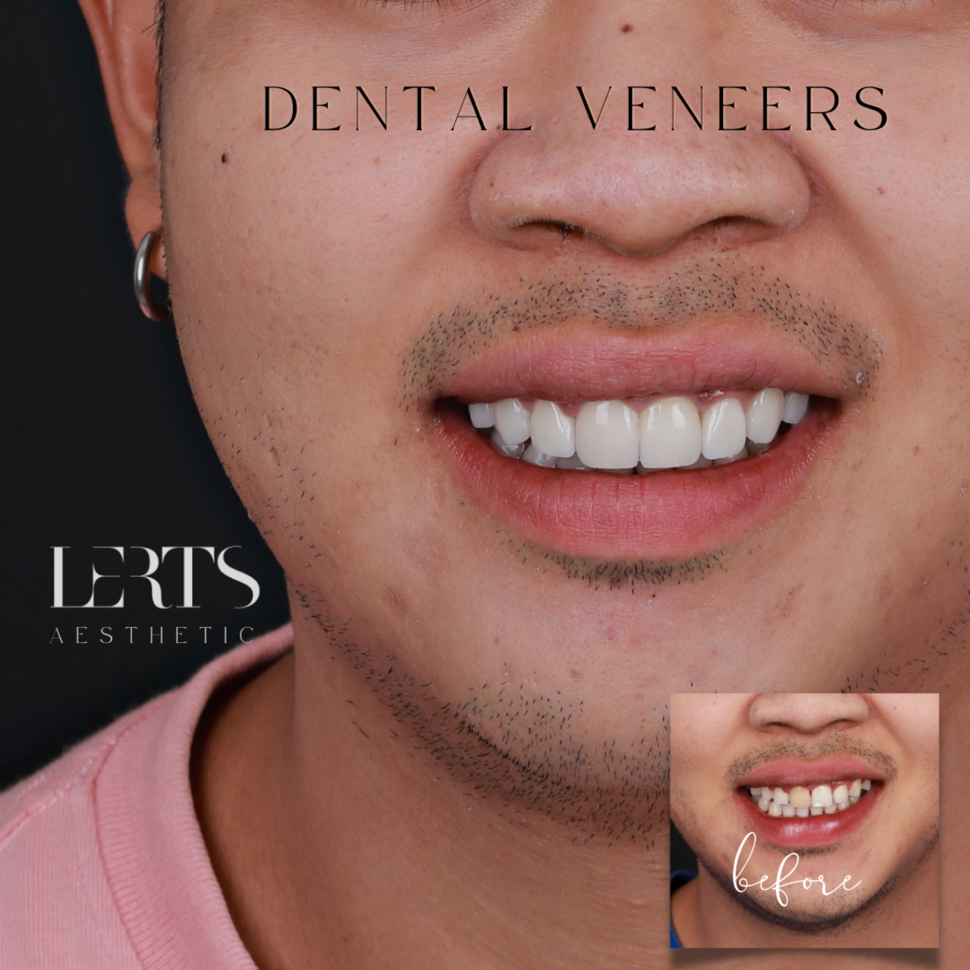 Veneer case 12