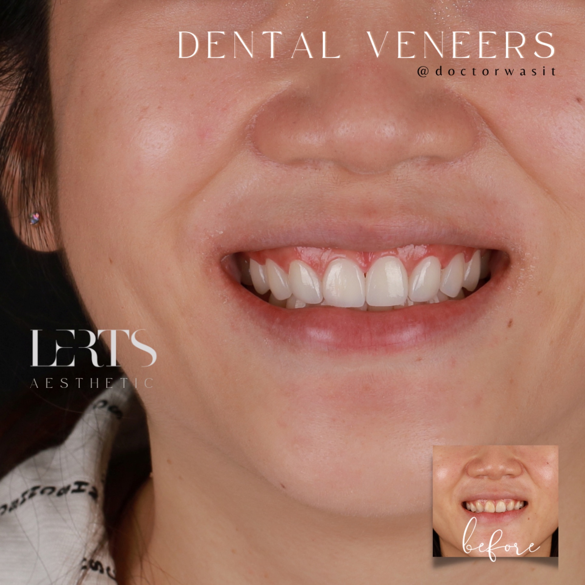 Veneer case 14