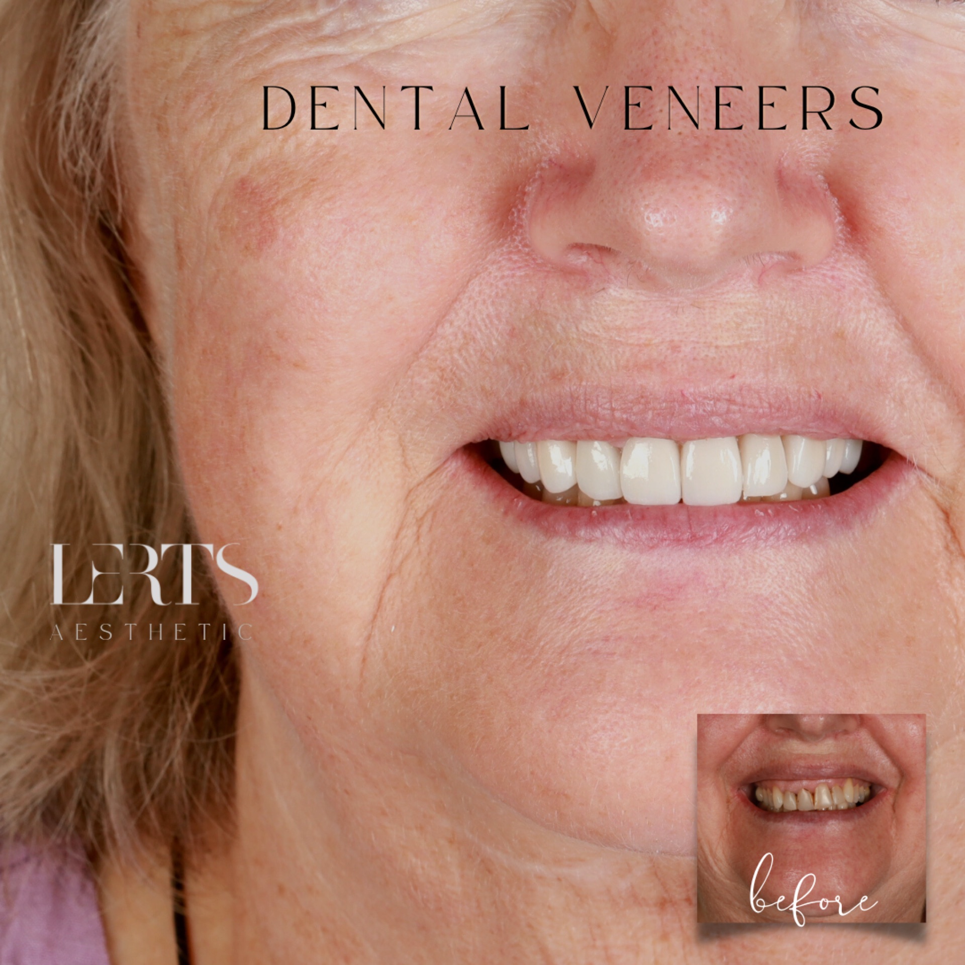 Veneer case 15