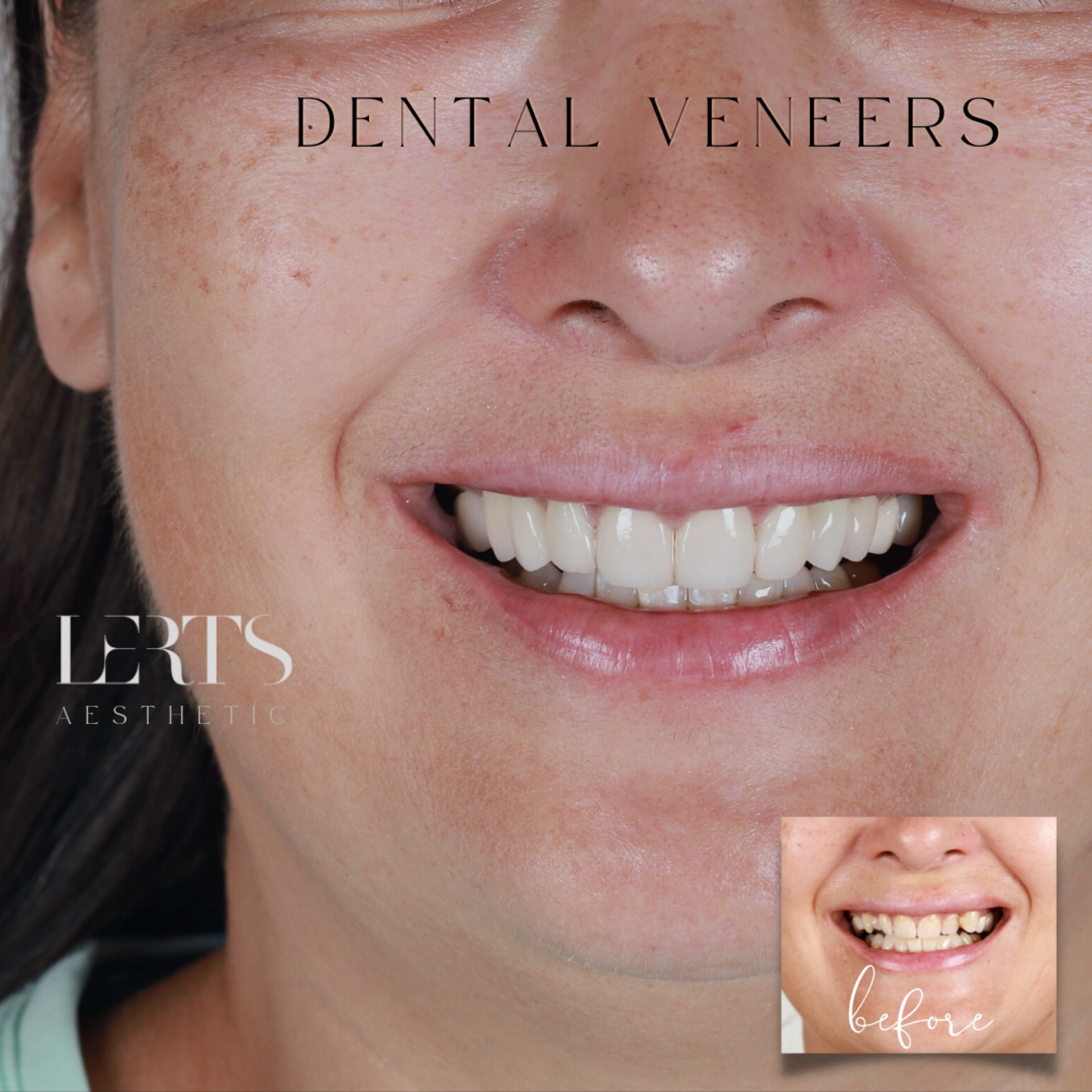 Veneer case 16