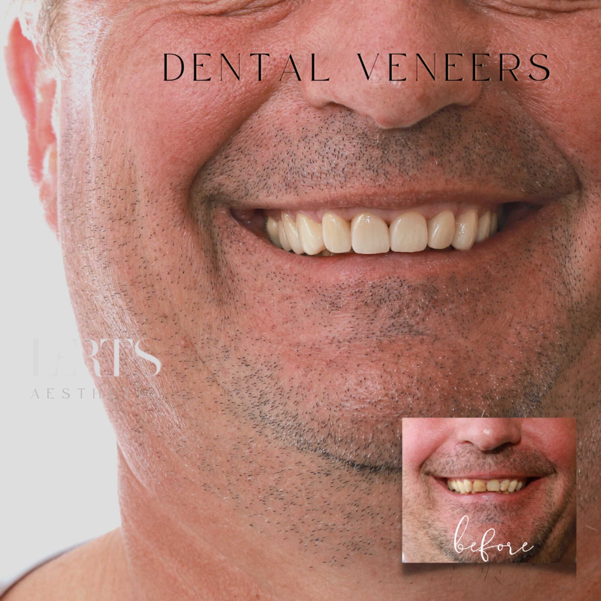 Veneer case 18