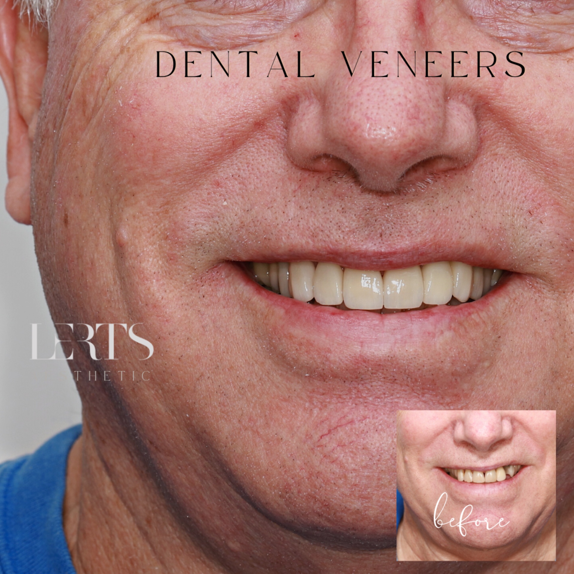Veneer case 19