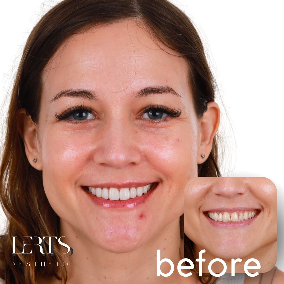 Ceramic veneers over a dental implant — natural translucency restored