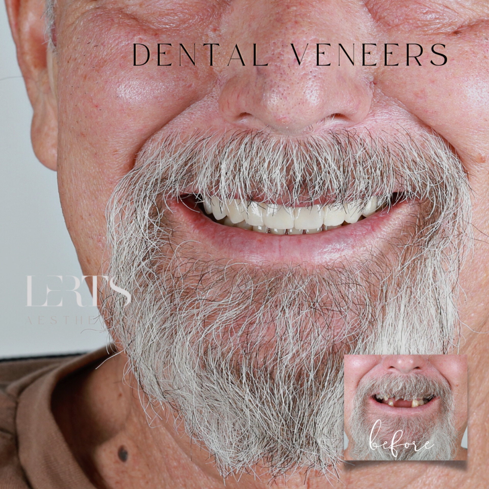 Before & after — veneers case 10