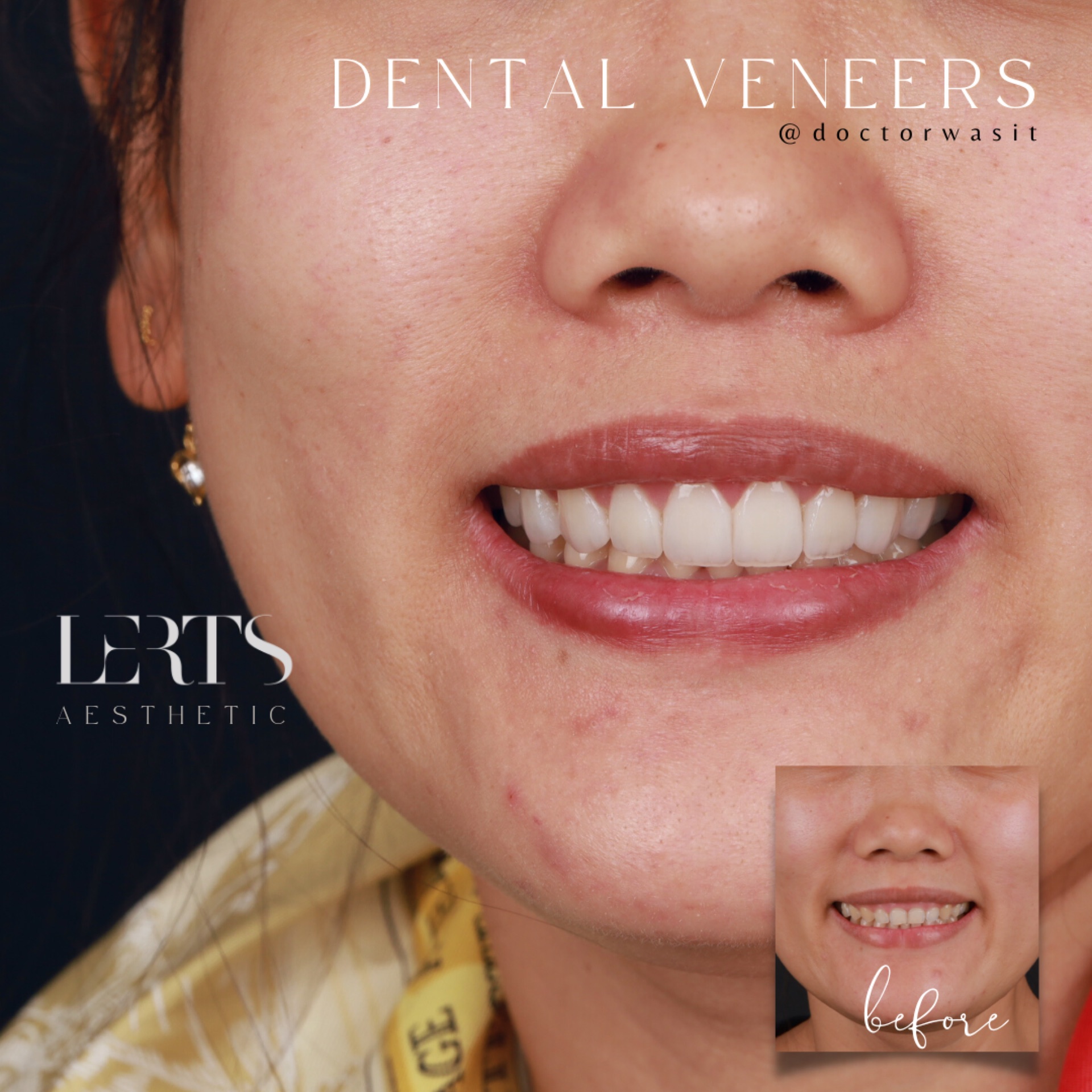 Before & after — veneers case 11