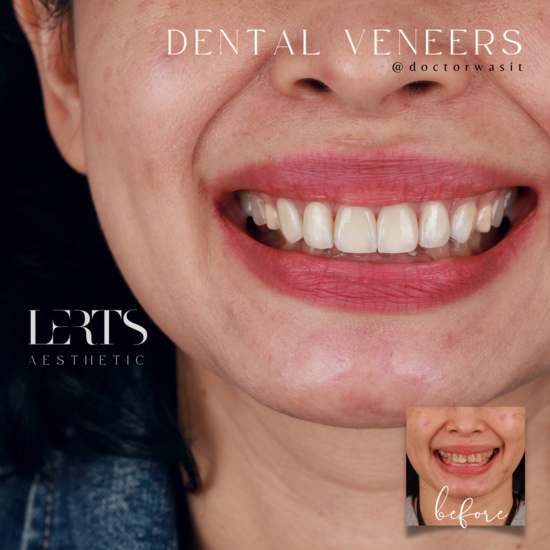 Before & after — veneers case 13