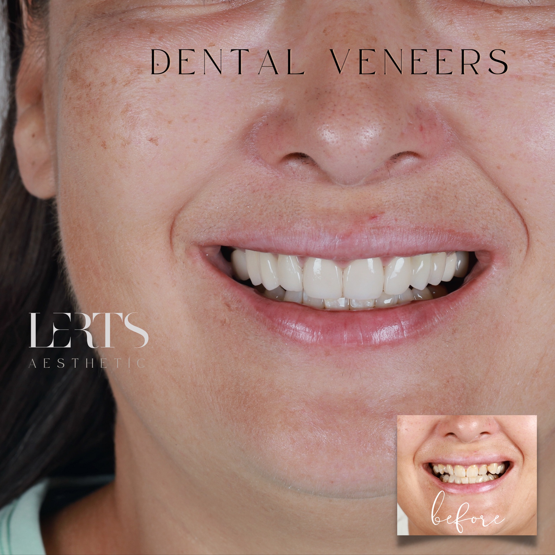 Before & after — veneers case 20