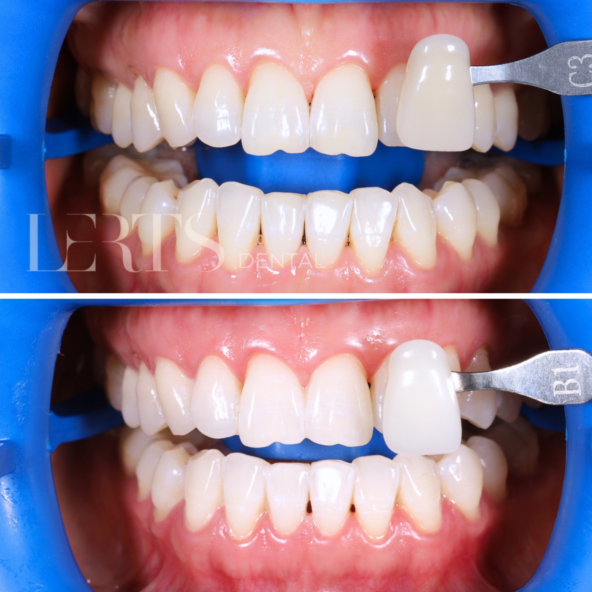 Zoom whitening before / after — 6 shades brighter