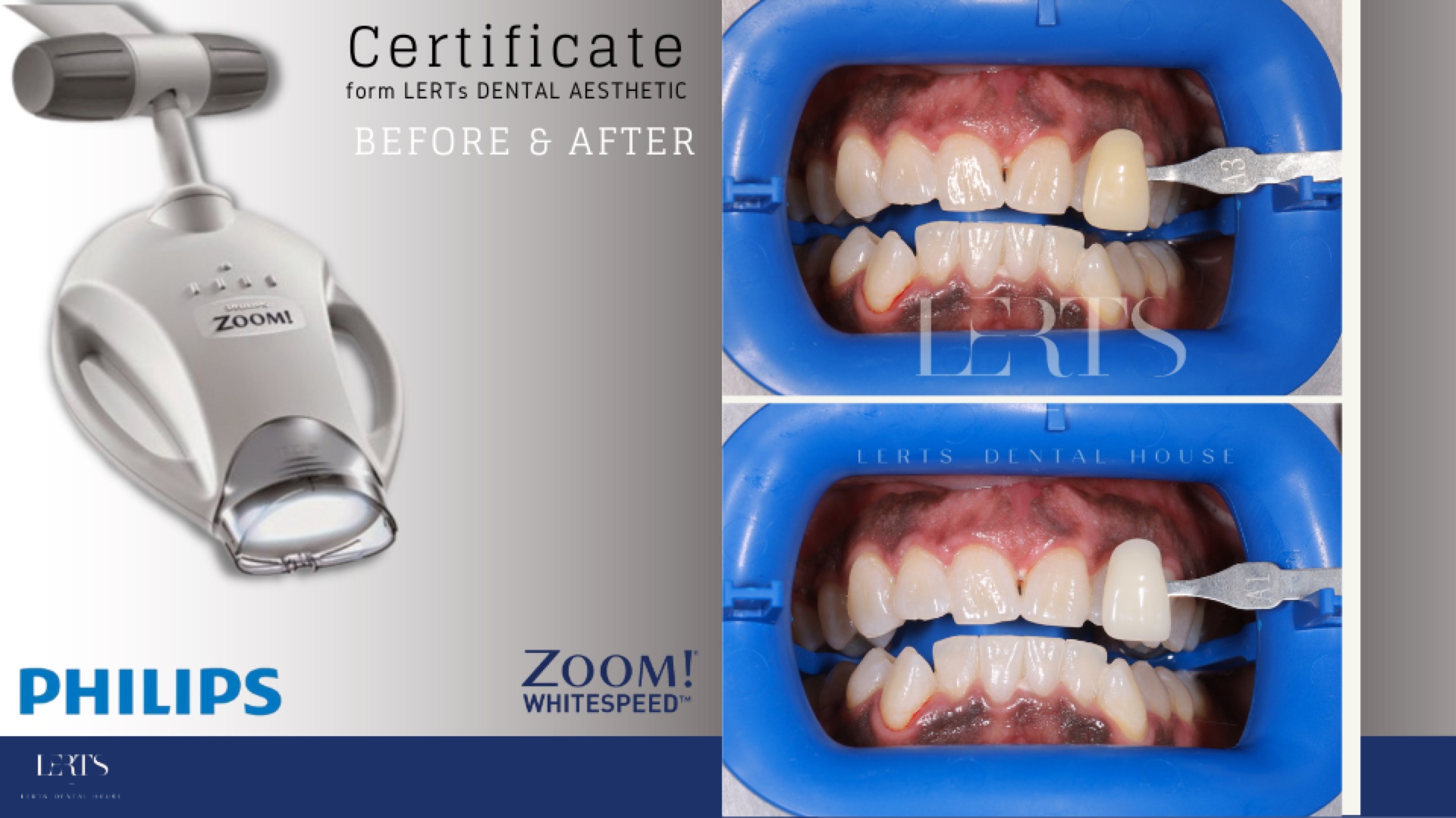 Zoom whitening before / after — 7 shades brighter