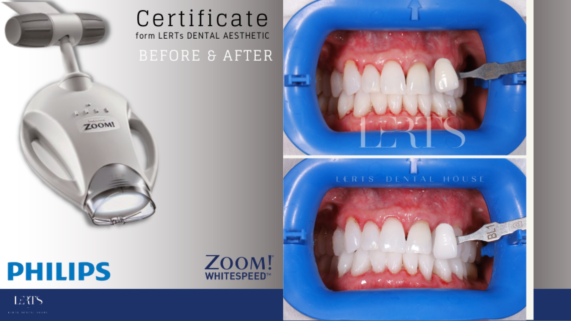Zoom whitening before / after — 5 shades brighter