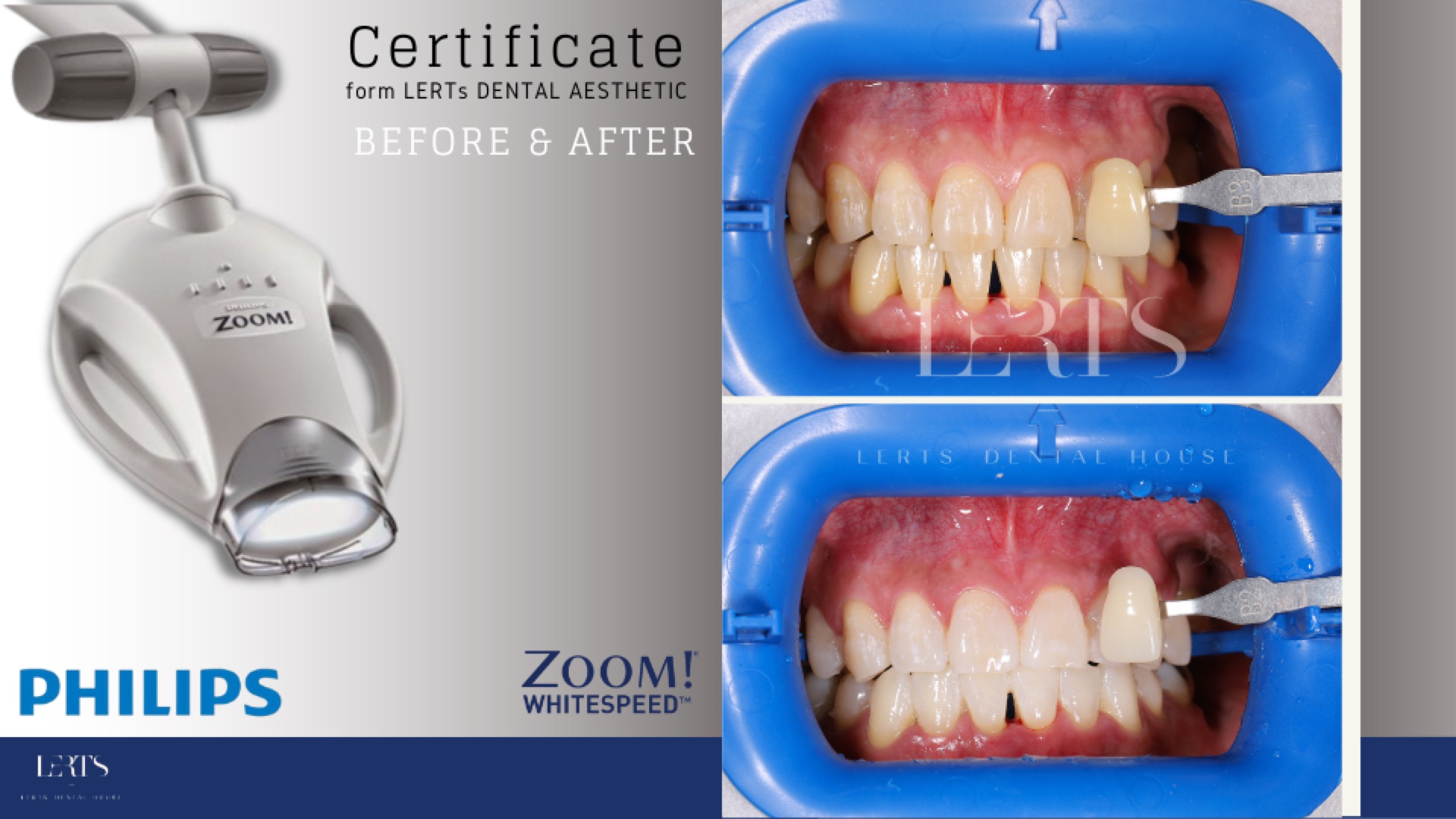 Zoom whitening before / after — 6 shades brighter