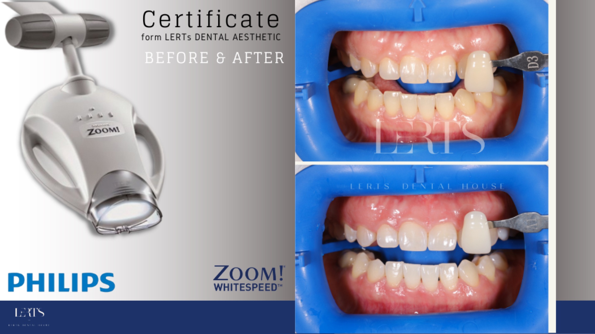Zoom whitening before / after — 7 shades brighter