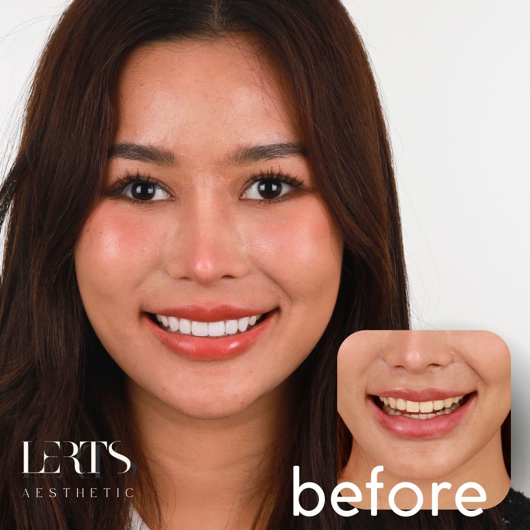Smile design — porcelain veneers, 7 days
