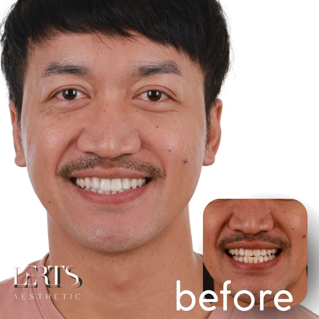Complete smile makeover